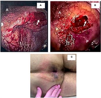 Case Report: Resolution of high grade anal squamous intraepithelial lesion with antibiotics proposes a new role for syphilitic infection in potentiation of HPV-associated ASCC